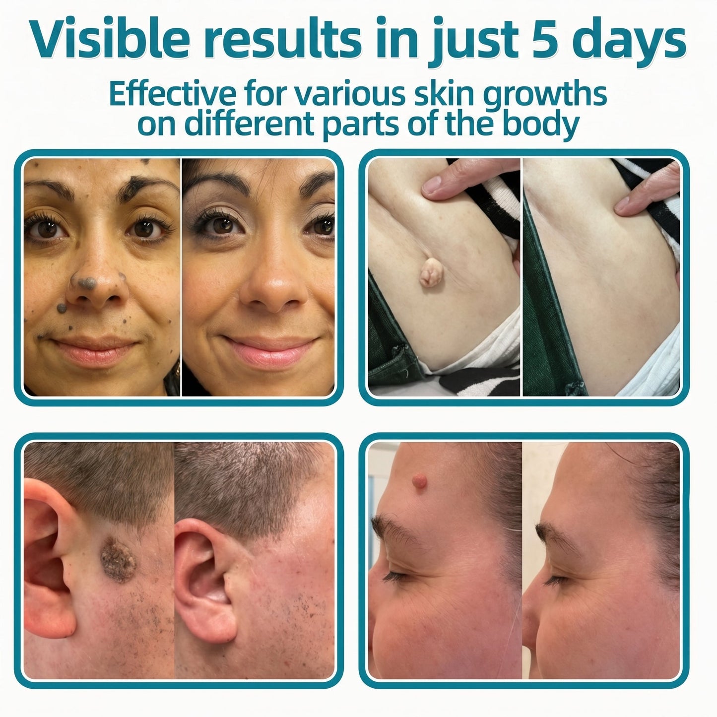 ✅🇺🇸𝐇𝐞𝒂𝒍𝗿𝗶𝙯𝙚®2-in-1 Microneedle & Hydrocolloid Patch🛡️| Removes Raised Moles, Acne, Flat Warts & Skin Tags | Helps Improve Wrinkles, Scars & Blemishes | Invisible Patches for Face & Body