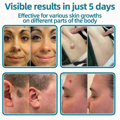 ✅🇺🇸𝐇𝐞𝒂𝒍𝗿𝗶𝙯𝙚®2-in-1 Microneedle & Hydrocolloid Patch🛡️| Removes Raised Moles, Acne, Flat Warts & Skin Tags | Helps Improve Wrinkles, Scars & Blemishes | Invisible Patches for Face & Body