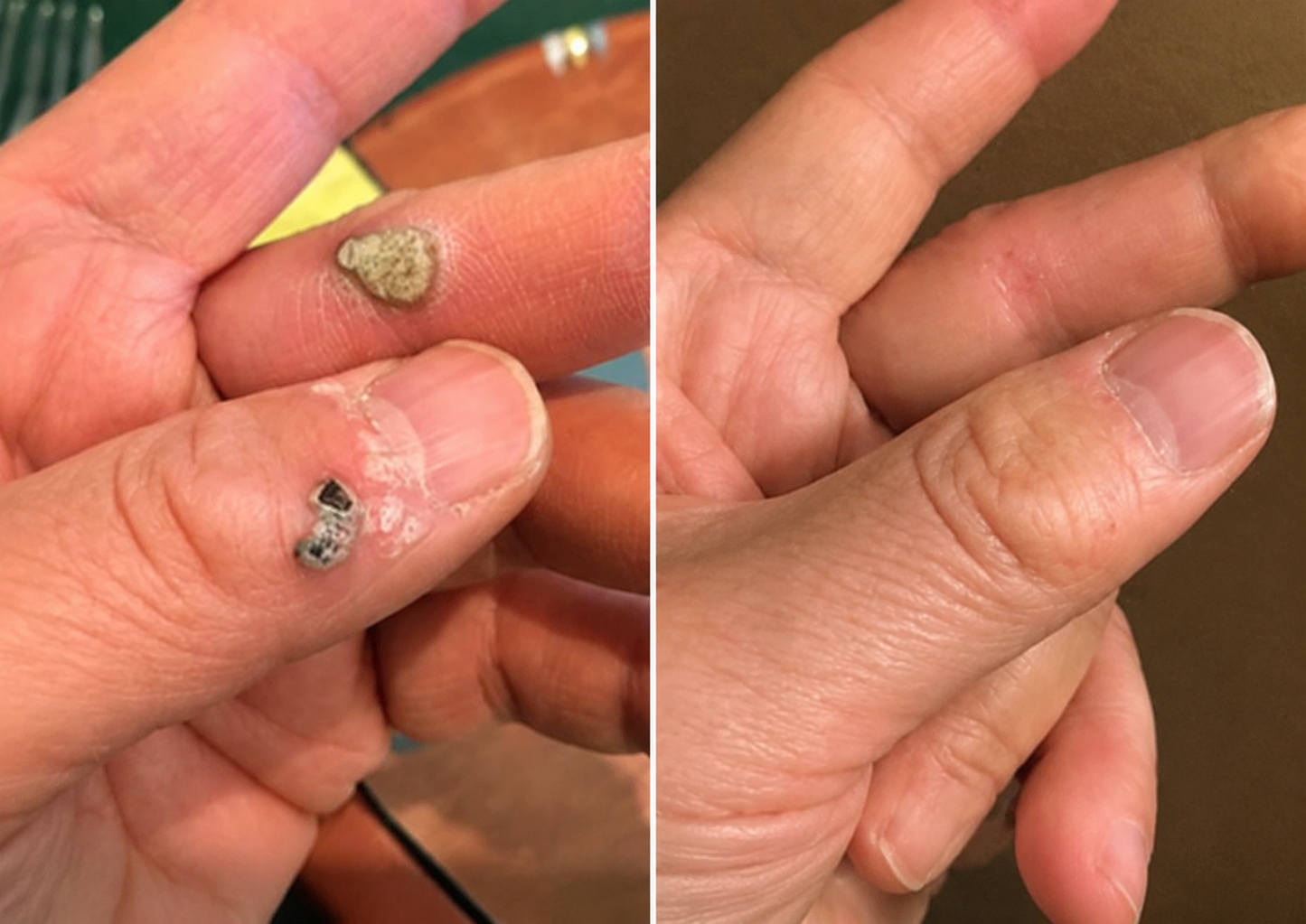 ✅🇺🇸𝐇𝐞𝒂𝒍𝗿𝗶𝙯𝙚®2-in-1 Microneedle & Hydrocolloid Patch🛡️| Removes Raised Moles, Acne, Flat Warts & Skin Tags | Helps Improve Wrinkles, Scars & Blemishes | Invisible Patches for Face & Body