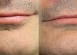 ✨✨𝐌𝗢𝑷𝙍𝙊® 2-in-1 Microneedle & Hydrocolloid Patch🌈| Removes Raised Moles, Acne, Flat Warts & Skin Tags | Helps Improve Wrinkles, Scars & Blemishes | Invisible Patches for Face & Body