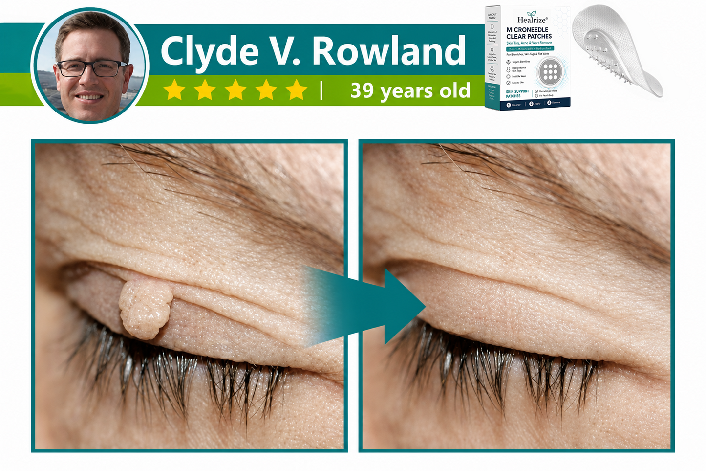 ✅🇦🇺𝐇𝐞𝒂𝒍𝗿𝗶𝙯𝙚®2-in-1 Microneedle & Hydrocolloid Patch💝| Removes Raised Moles, Acne, Flat Warts & Skin Tags | Helps Improve Wrinkles, Scars & Blemishes | Invisible Patches for Face & Body