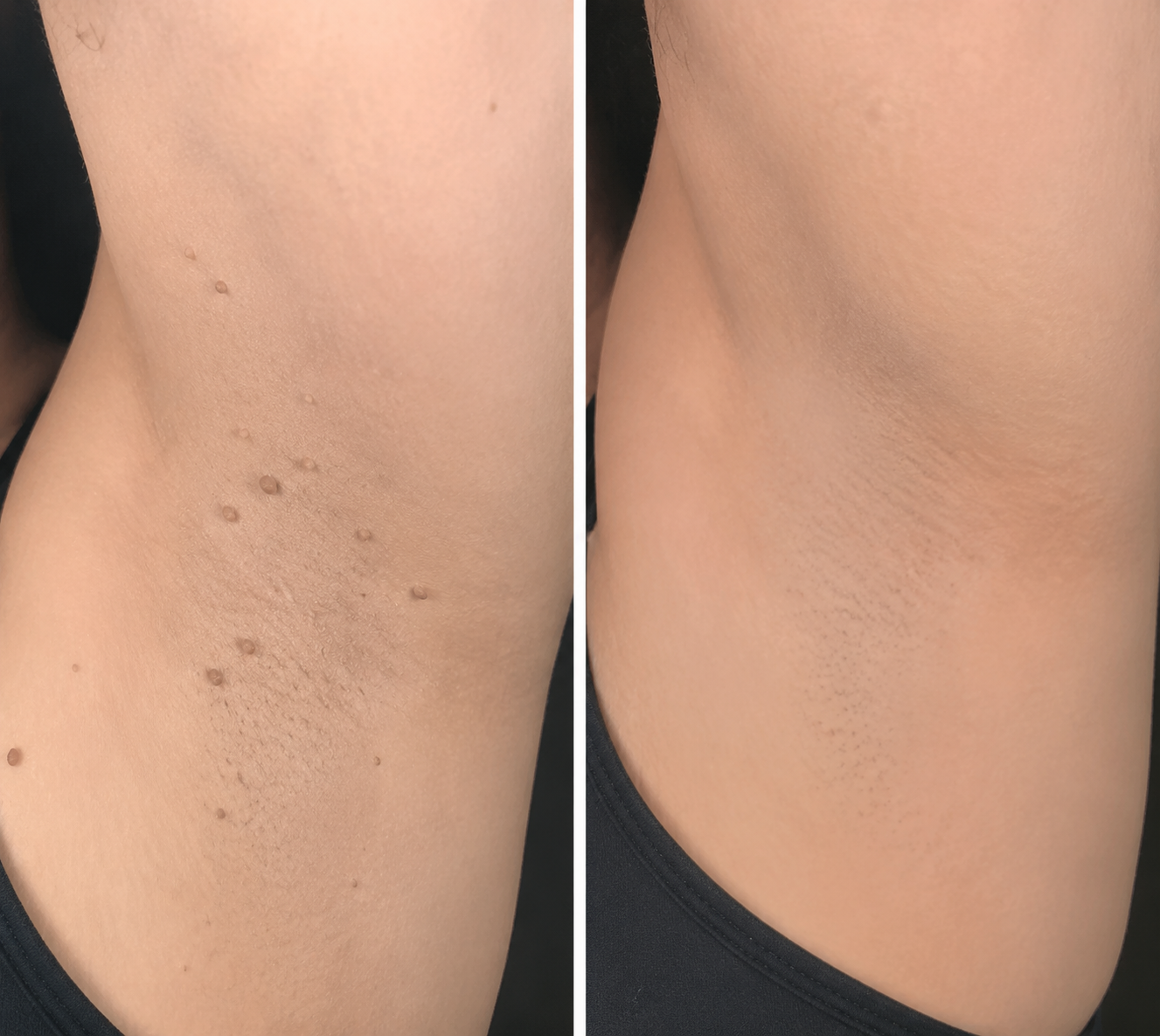 ✨✨𝐌𝗢𝑷𝙍𝙊® 2-in-1 Microneedle & Hydrocolloid Patch🌈| Removes Raised Moles, Acne, Flat Warts & Skin Tags | Helps Improve Wrinkles, Scars & Blemishes | Invisible Patches for Face & Body