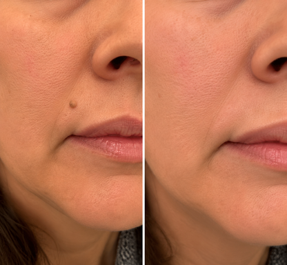 ✨✨𝐌𝗢𝑷𝙍𝙊® 2-in-1 Microneedle & Hydrocolloid Patch🌈| Removes Raised Moles, Acne, Flat Warts & Skin Tags | Helps Improve Wrinkles, Scars & Blemishes | Invisible Patches for Face & Body